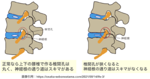 中腰で腰痛があり足まで痺れる時の原因と対処法