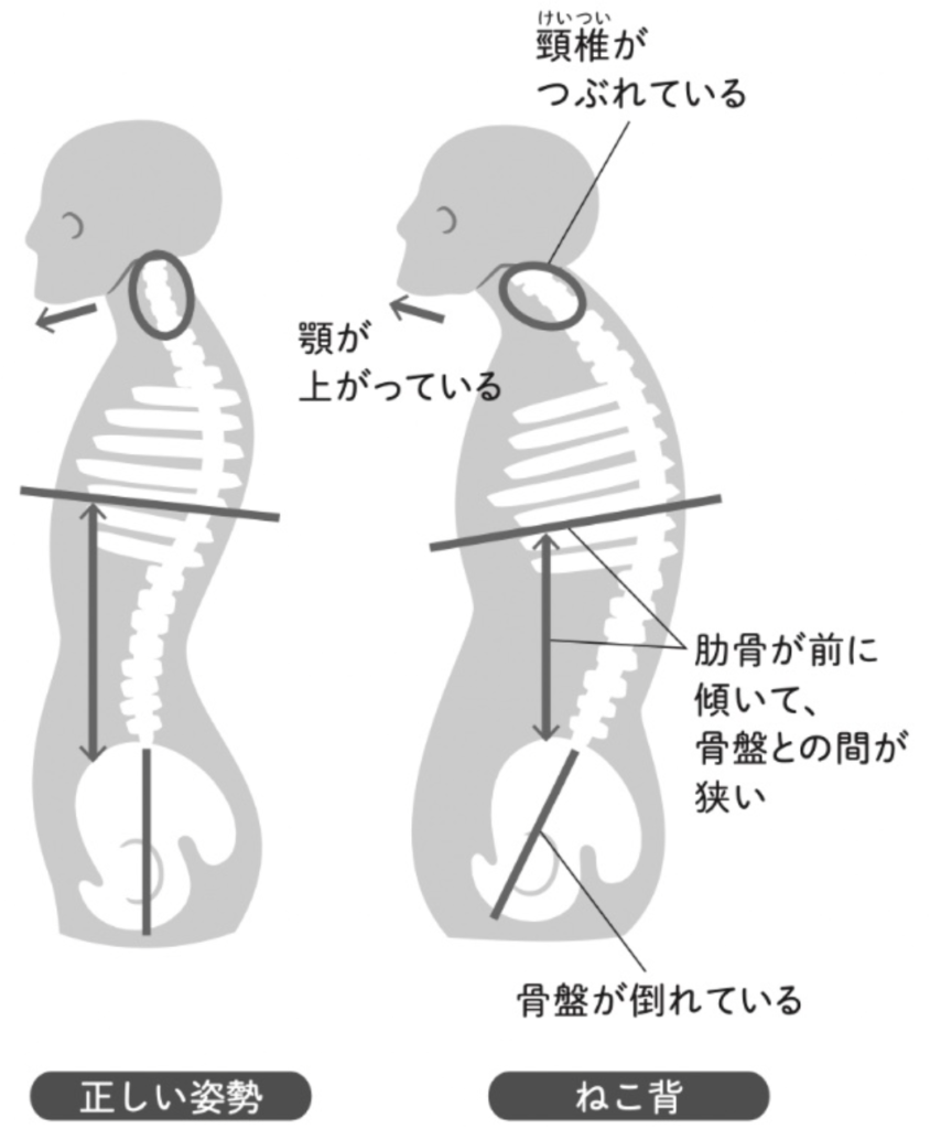 ねこ背の原因１：骨盤が後傾している