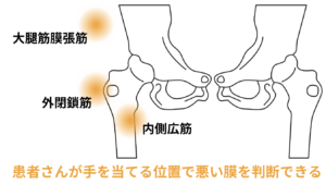 股関節　痛い場所で原因特定