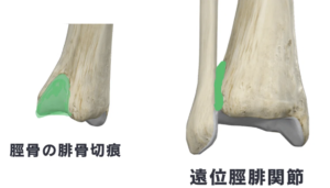 足底筋膜炎　下脛腓関節