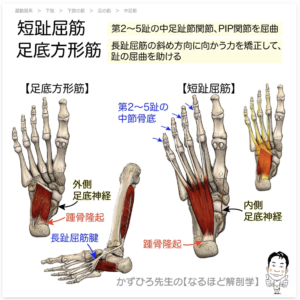 足底筋膜炎