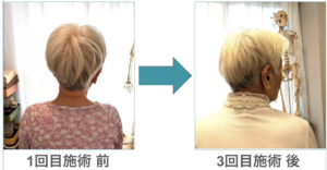 整体 肩こり